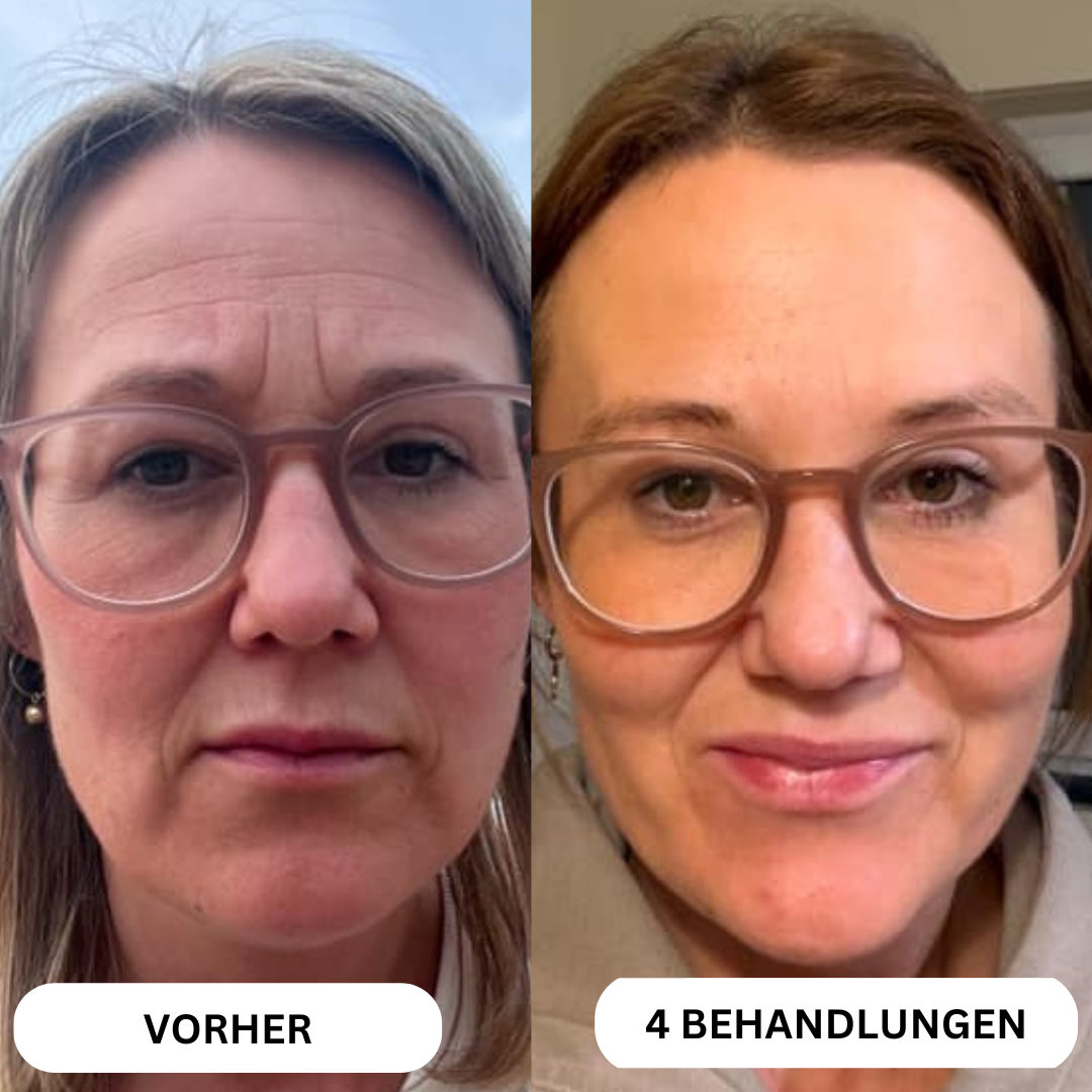 Natural Botulin 8-Wochen-Microinfusion-System™