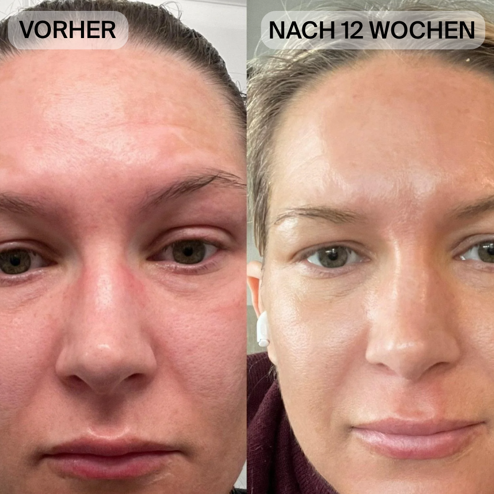 Natural Botulin LED-Infrarot-Maske