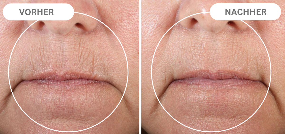 Natural Botulin Serum After Inject