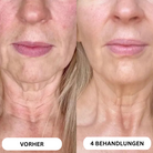 Système de micro-infusion de toxine botulique naturelle sur 8 semaines™