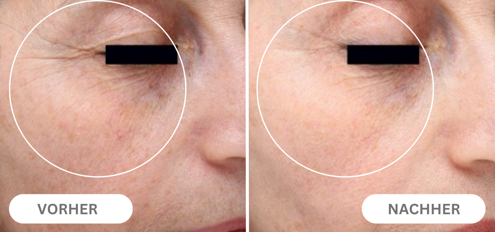 Natural Botulin Serum After Inject