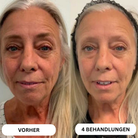Système de micro-infusion de toxine botulique naturelle sur 8 semaines™