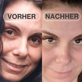 Natural Botulin Microneedling Patches