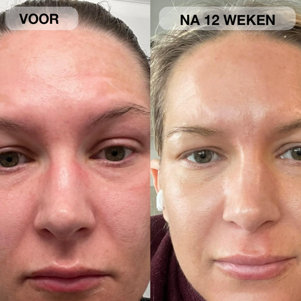 Natural Botulin LED-infraroodmasker