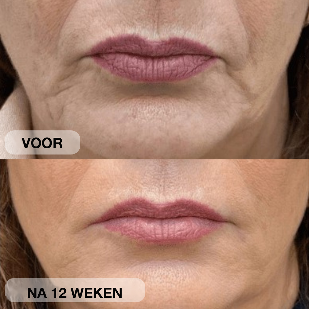 Natural Botulin LED-infraroodmasker