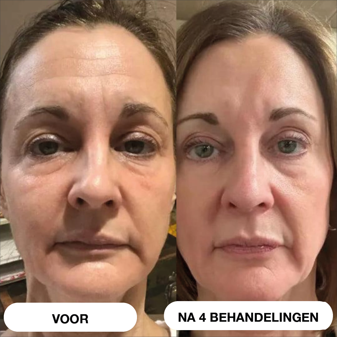 Natural Botulin 8-weken-micro-infusiesysteem™