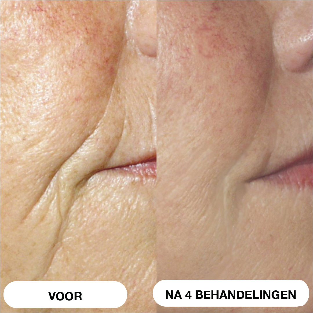 Natural Botulin 8-weken-micro-infusiesysteem™
