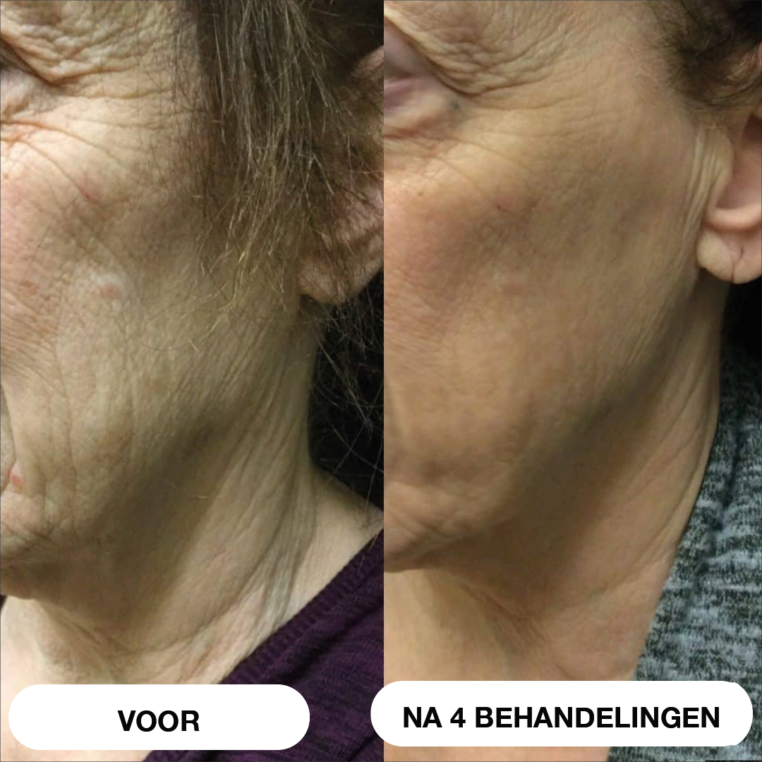 Natural Botulin 8-weken-micro-infusiesysteem™