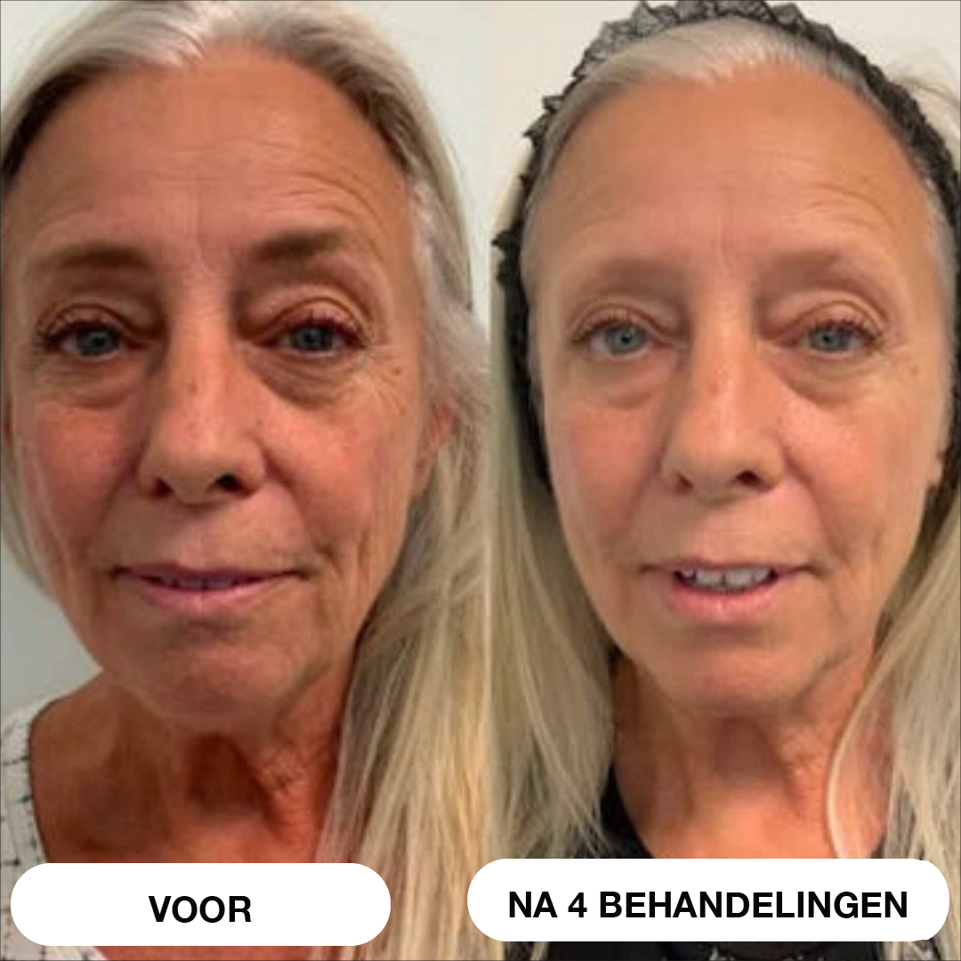 Natural Botulin 8-weken-micro-infusiesysteem™